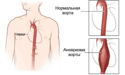 Durerea în stern în mijlocul inhalării, presării, mișcării - cauzelor