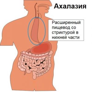 Біль в грудині посередині при вдиху, при натисканні, при русі - причини