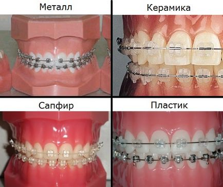 Брекети в Санкт-Петербурзі ціни, розрахунок вартості лікування, відгуки, види брекет-систем, спб