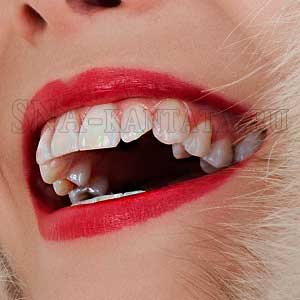 Simptomele bruxismului de sclipire a dintilor