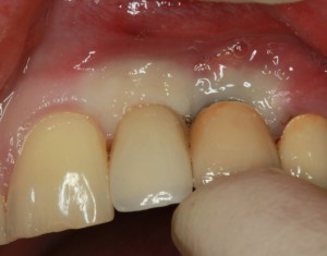 Що відрізняє імплантати від зубів, імплантаріум