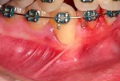 Ceea ce distinge implanturile de dinți, implantarium