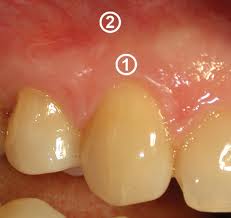 Що відрізняє імплантати від зубів, імплантаріум