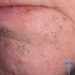 Що таке акне - визначення і опис acne vulgaris