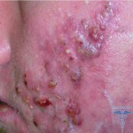 Що таке акне - визначення і опис acne vulgaris