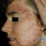 Що таке акне - визначення і опис acne vulgaris