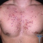Що таке акне - визначення і опис acne vulgaris