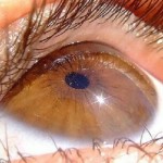 Ce este angiopatia retiniană prin tip hipotonic