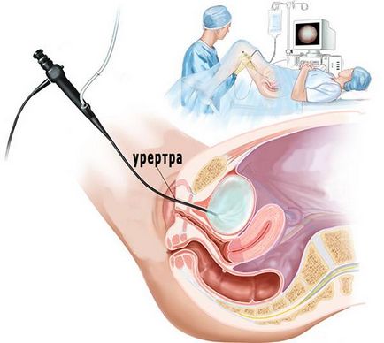 Care este cystoscopia speciilor, indicații, contraindicații