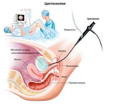 Cistoscopia indicațiilor vezicii urinare și tehnica de efectuare a acestora