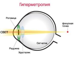 Hiperopia la copii până la un an când au nevoie de tratament