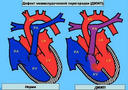 Defectul septului interventricular la nou-născuți și copii