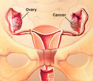 Chistul ovarian dermoid provoacă apariția, simptomele, tratamentul și îndepărtarea