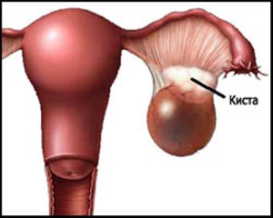 Chistul ovarian dermoid provoacă apariția, simptomele, tratamentul și îndepărtarea