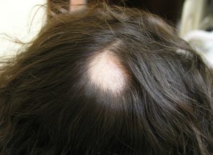 Dermovează cu alopecie