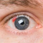 Diareea edemului macular se apropie de tratamentul cu maculopatie