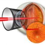 Diareea edemului macular se apropie de tratamentul cu maculopatie