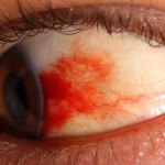 Diareea edemului macular se apropie de tratamentul cu maculopatie