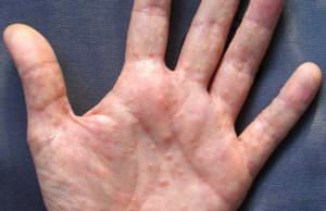Dyshydrosis kezek, lábak és a bőr kezelések, okok és képek