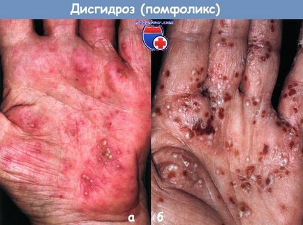 Dyshydrosis (pomfoliks) ръце и крака
