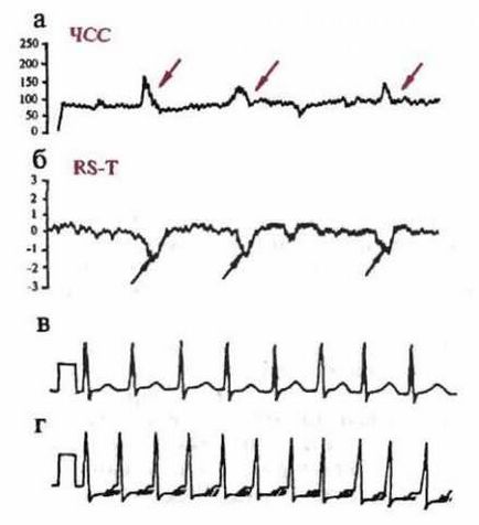 Monitorizarea pe termen lung a ECG pe Holter, ilab