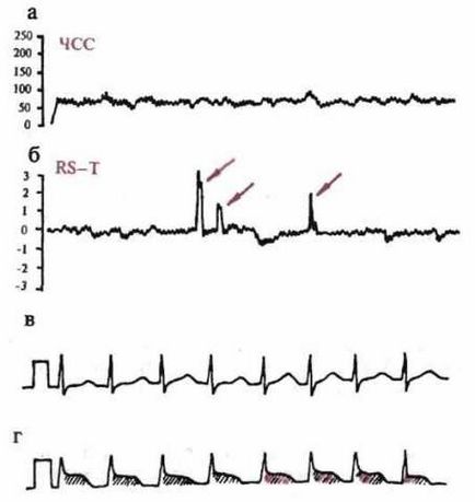 Monitorizarea pe termen lung a ECG pe Holter, ilab