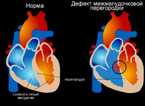 ДМШП - дефект міжшлуночкової перегородки