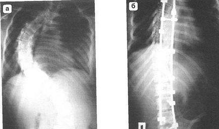 Tratamentul chirurgical în două trepte a scoliozelor severe