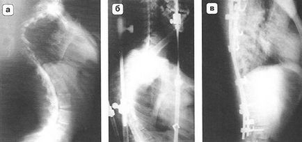 Tratamentul chirurgical în două trepte a scoliozelor severe