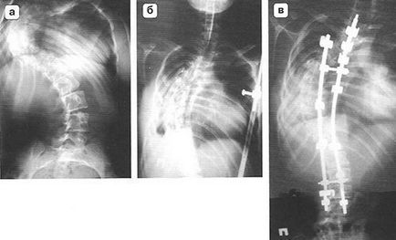 Tratamentul chirurgical în două trepte a scoliozelor severe