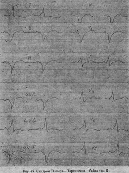 EKG jelek (kamra hasonlít a blokád) EKG jelek