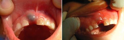 Фолікулярна кіста зуба симптоми, причини, лікування, ціни і вартість в москві на лікування