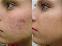Fototerapia acneei