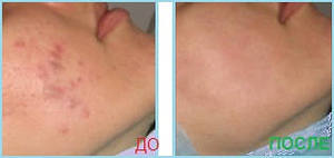 Fototerapia acneei