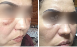 Sistemul fracțional de laser - halo (grindină), o noutate în domeniul cosmetologiei hardware laser