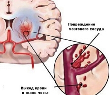 Геморагічний інсульт головного мозку що це таке і які наслідки