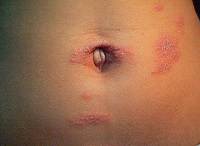 Herpesul pe abdomen și în buricul cauzei, tratamentul