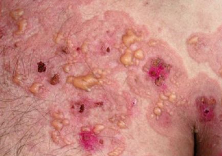 Herpetiform dermatitis duhringa cauzează, simptome, tratament și dietă pentru dermatita vesiculară