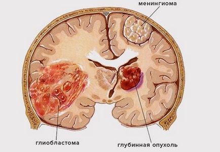 Гліобластома головного мозку симптоми, лікування, прогноз