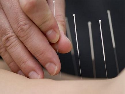 Acupunctura de la fumat argumente pro și contra ale acestei metode