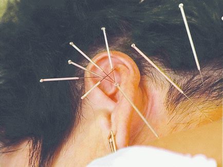 Acupunctura de la fumat argumente pro și contra ale acestei metode