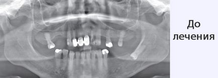 Implanturile ihde dentare, clinica de implantologie elvețiană - implantarea dinților în St. Petersburg