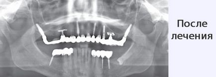 Implanturile ihde dentare, clinica de implantologie elvețiană - implantarea dinților în Sankt Petersburg