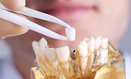 Імплантація або протезування зубів, Стоматологія люксар в Красноярську