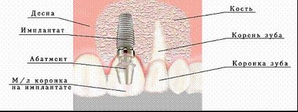 implantátumok és fogászati ​​implantátumok a fogászatban