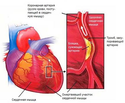 Infarctul miocardic - știința câștigului - natura medicului