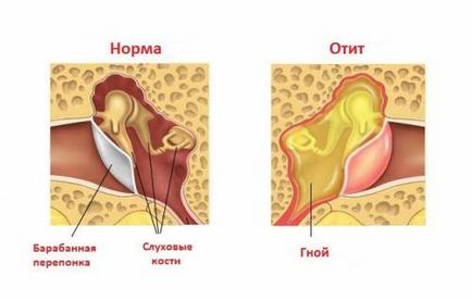 Інструкція як закопувати фураціліновая спирт у вухо при отиті