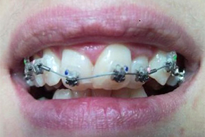 Corectarea ocluziunii la adulți a prețului egalizării dinților cu capac și bretele - stomatologie 