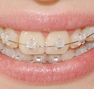 Виправлення прикусу у дорослих ціни на вирівнювання зубів капою і брекетами - стоматологія «все
