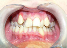 Виправлення прикусу у дорослих ціни на вирівнювання зубів капою і брекетами - стоматологія «все